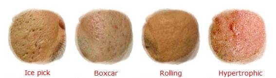 Acne-scars-types