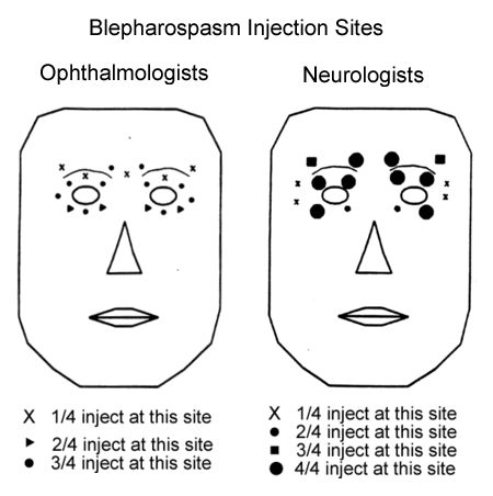 blepharospasm-botox-injection-sites-7lwbalhn