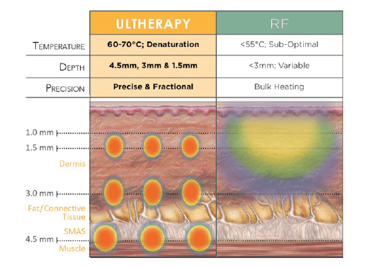 ultherapy-va-thermage