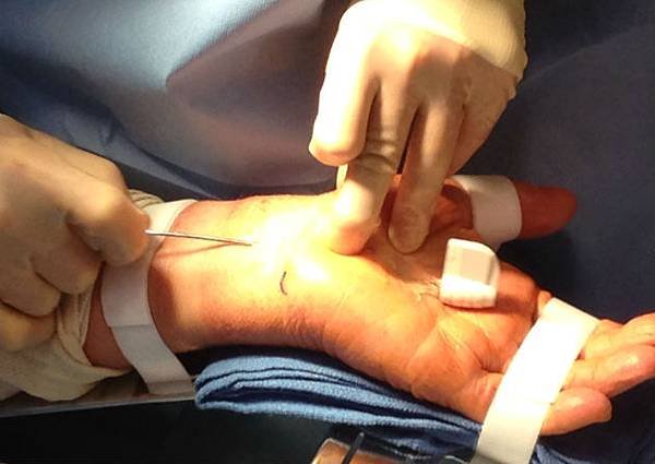 MANOS-CTR-Procedure-Surgeon-cutting-transverse-carpal-ligament-flexor-retinaculum2