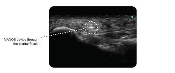 Manos-PFR-ultrasound-img02