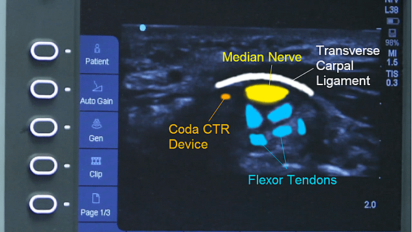 Coda-CTR-procedure-ultrasound-structures