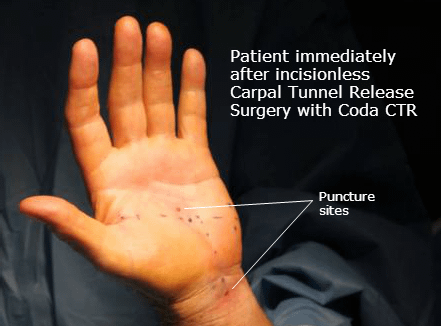 Incisionless-Carpal-Tunnel-Release-Surgery-Coda-CTR