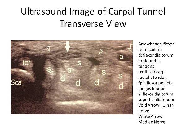 ultrasound-image-of-carpal-tunnel