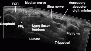 Normal Sonographic Appearance of the Carpal Tunnel