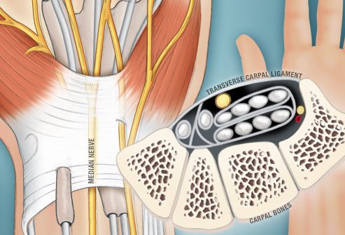 webmd_rf_photo_of_carpal_tunnel_illustration