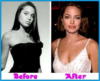 angelina-jolie-before-plastic-surgery