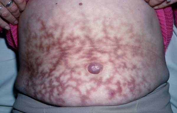 Erythema_ab_igme-8