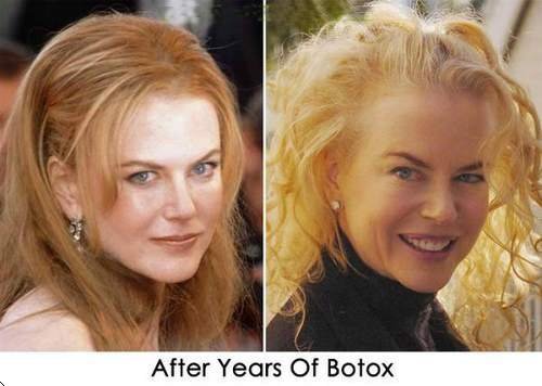 nicole_kidman_botox