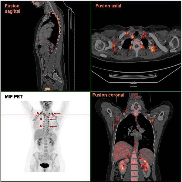 Brownfat_PETCT