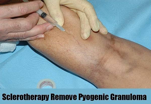 Sclerotherapy1