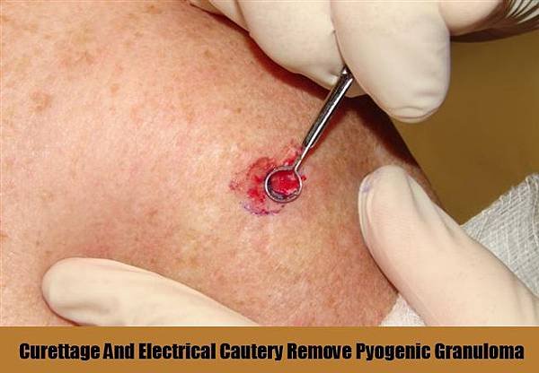 Curettage-And-Electrical-Cautery