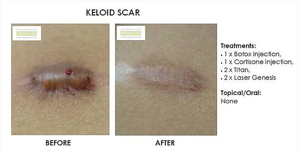 keloid_scarring_-__botox,_cortisone,_titan_x2,_laser_genesis_x2__slider_image