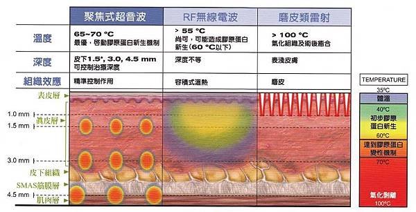 ultherapy 極線音波拉皮