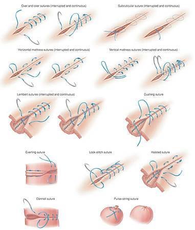 suture