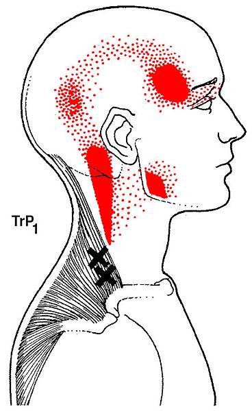 trapezius-trigger-points.jpg