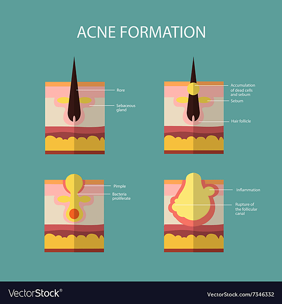 Cách Trị Mụn Nhọt Ở Vùng Kín: 