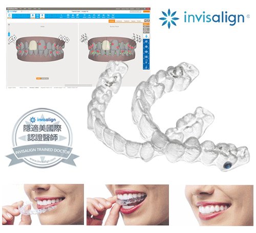 invisalign_4.jpg