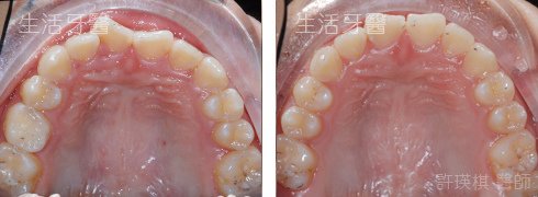 台中透明矯正牙套推薦牙醫