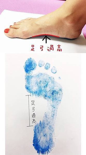 足弓圖