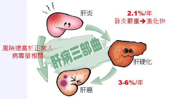 肝癌,肝硬化治療