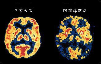 阿茲海默症