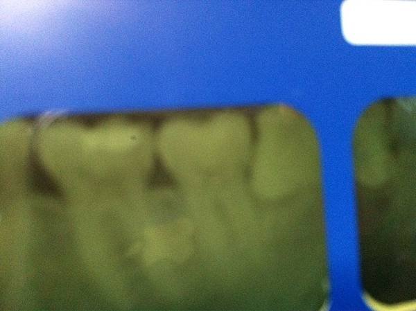 wisdom teeth
