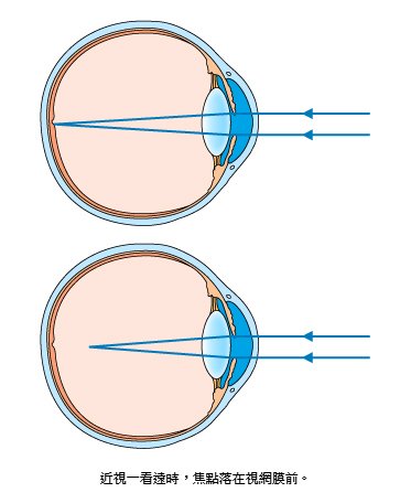 29 近視.jpg