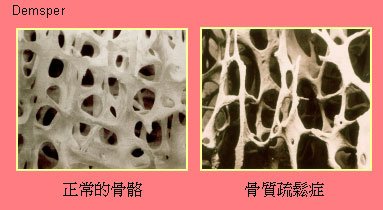 骨質疏鬆.jpg