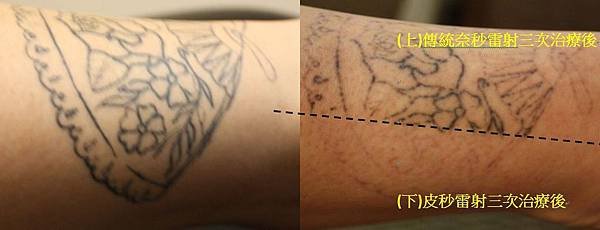 PicoSure tatoo effect2