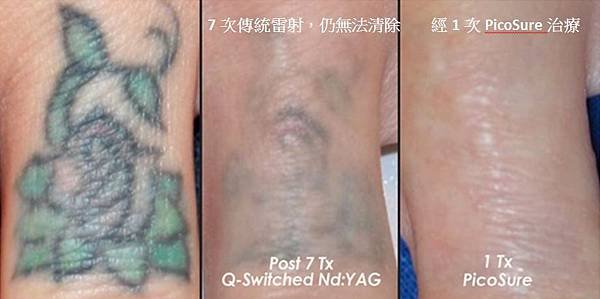 PicoSure tatoo effect3