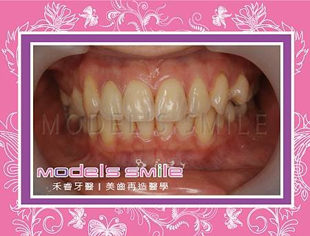 甲小姐術後.jpg
