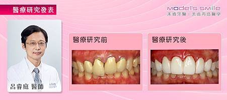 【台北植牙+全瓷冠案例】假牙咬合設計不良 進食困難麵條咬不斷