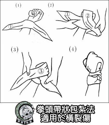 拳頭帶狀包紮法-橫裂傷