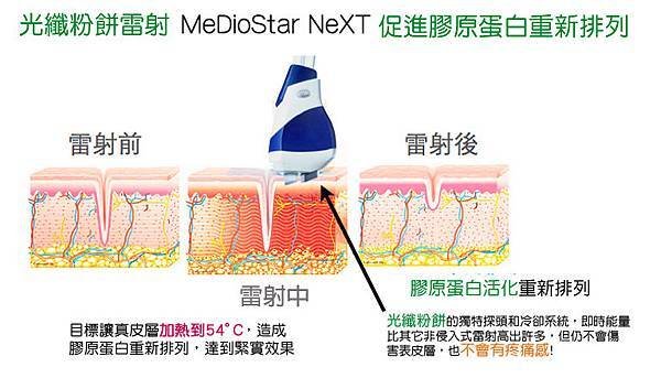 痘痘粉刺杏仁酸換膚果酸換膚痘疤毛孔粗大美白黑色素淡化光纖粉餅雷射暗沉膚色不均縮小毛孔美麗晶華晶亮瓷微晶瓷隆鼻玻尿酸隆鼻02.jpg