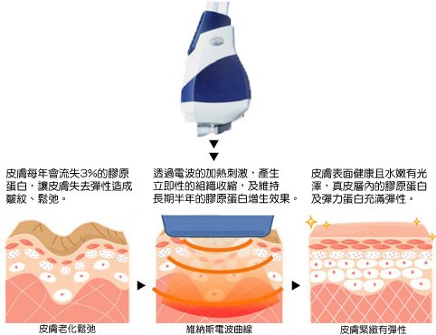 光纖粉餅雷射膚色暗沉色素沉澱黑眼圈痘疤淡斑膠原蛋白拉提4D羽毛線拉提納斯曲線電波皺紋法令紋嘴邊肉抬頭紋眼周細紋木偶紋6.jpg