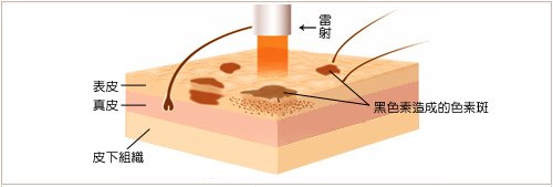 光纖粉餅雷射膚色暗沉色素沉澱黑眼圈痘疤淡斑膠原蛋白拉提4D羽毛線拉提納斯曲線電波皺紋法令紋嘴邊肉抬頭紋眼周細紋木偶紋4.jpg