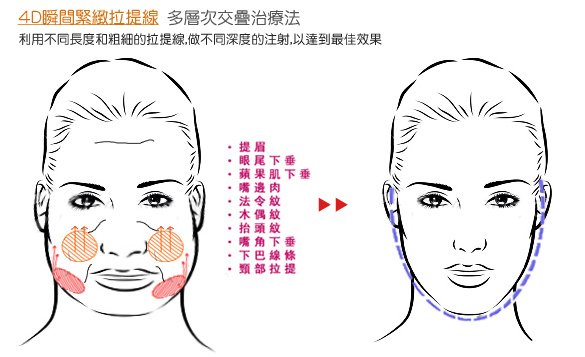 光纖粉餅雷射膚色暗沉色素沉澱黑眼圈痘疤淡斑膠原蛋白拉提4D羽毛線拉提納斯曲線電波皺紋法令紋嘴邊肉抬頭紋眼周細紋木偶紋7.jpg