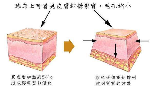 光纖粉餅雷射蘋果肌玻尿酸3D聚左旋乳酸電波拉皮微晶瓷瓜子臉CPT電波拉皮維納斯曲線電波4D羽毛線拉提11.jpg