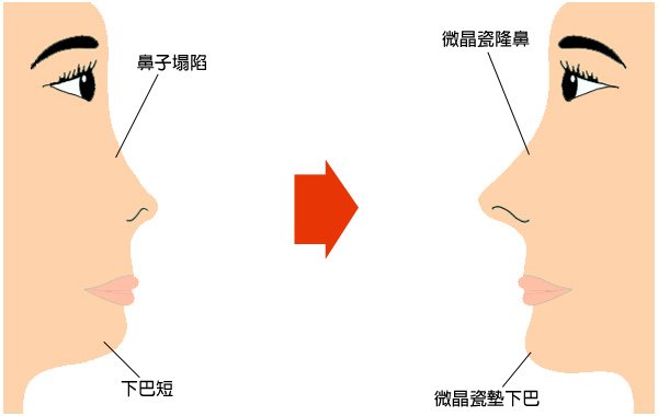 晶亮瓷微晶瓷隆鼻墊下巴玻尿酸蘋果肌膠原蛋白山根V臉10.jpg