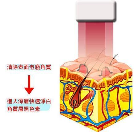 痘疤色素沉澱縮小毛孔膚色不均杏仁酸換膚高壓水涵氧換膚光纖粉餅雷射雷射光療12.jpg