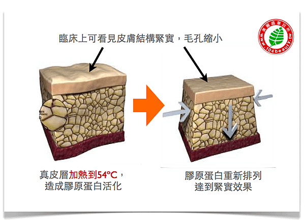 淨膚雷射 價格 淨膚雷射 保養 淨膚雷射 推薦 光纖粉餅雷射  價錢 光纖粉餅雷射 價格 美麗晶華 光纖粉餅雷射 飛梭雷射 推薦03.png