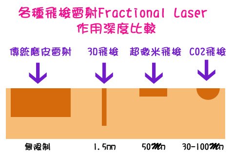 淨膚雷射 價格 淨膚雷射 保養 淨膚雷射 推薦 光纖粉餅雷射  價錢 光纖粉餅雷射 價格 美麗晶華 光纖粉餅雷射 飛梭雷射 推薦10.jpg