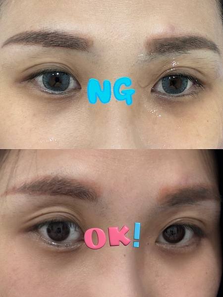 [保養]告別泡泡眼 ! 愛爾麗診所英國眼周離子刀