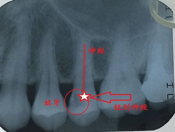 [根管治療] 為什麼我的牙齒不會痛牙醫師卻建議抽神經 高雄牙