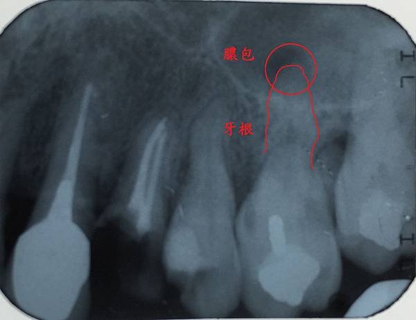 [根管治療] 神經已經抽掉了 怎麼還會痛呢? 高雄牙醫 根管