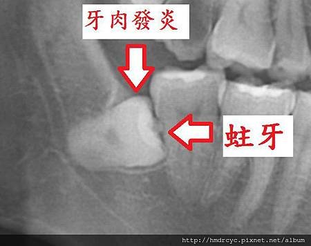 [拔牙手術] 牙齒是不是最好都保留? 牙齒最好不要拔? 高雄