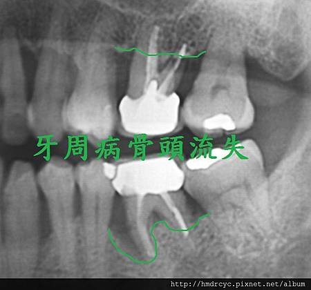 [假牙牙套] 怎麼知道假牙裡面的牙齒有沒有問題 高雄牙醫 假