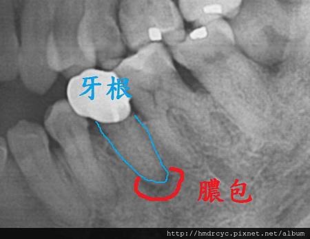 [假牙牙套] 怎麼知道假牙裡面的牙齒有沒有問題 高雄牙醫 假