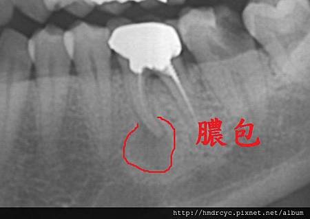 [假牙牙套] 怎麼知道假牙裡面的牙齒有沒有問題 高雄牙醫 假